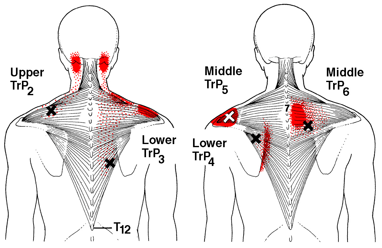 back-muscle-pain-under-right-shoulder-blade-burning-pain-between-your